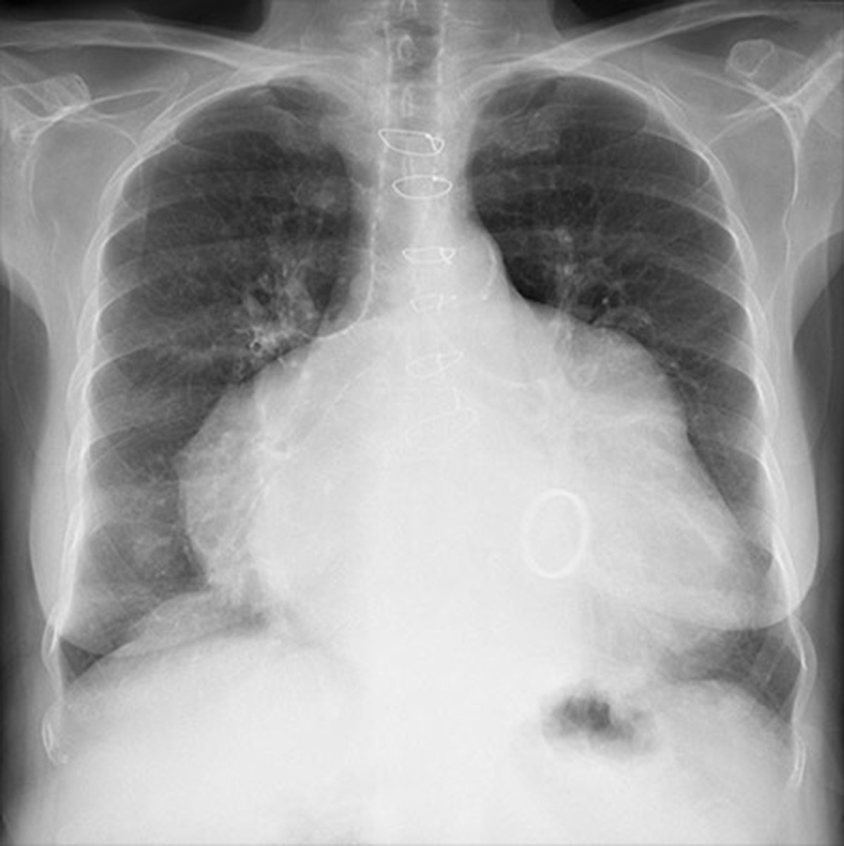 CHEST X-RAY 9: What signs of left atrial enlargement are visible? Answer - bit.ly/3OLnsP7