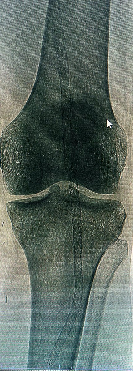 PSA to all PAD interventionalists.

Please, please, PLEASE send for a surgical evaluation ANY patient with a long segment SFA-Pop occlusion and a proximal tibial that is open.

A full metal jacket from the CFA INTO the last tibial either leads to amp or a high risk bypass.