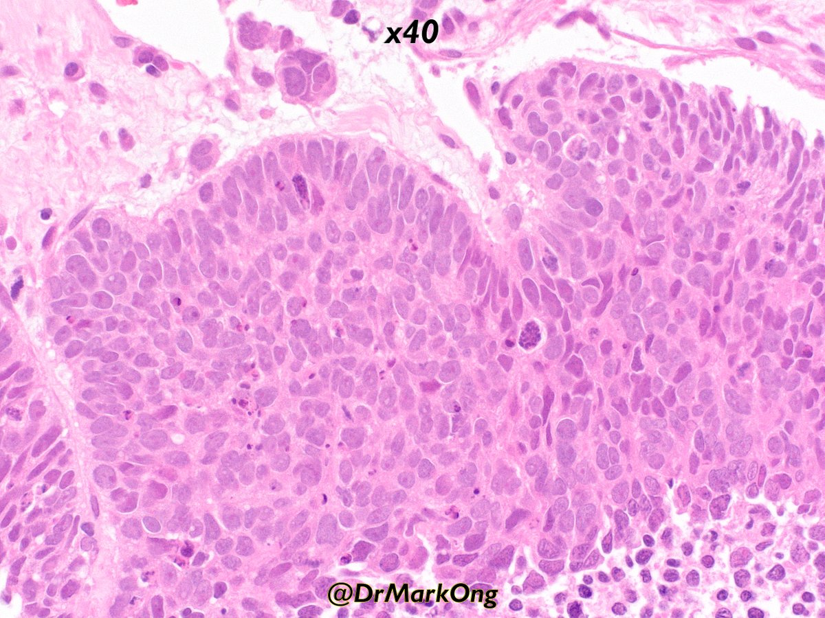 Liver metastasis in adult.

Diagnosis? AE1/AE3 and Ki67 in next tweet.

Can you tell the origin of the tumour?

#pathology