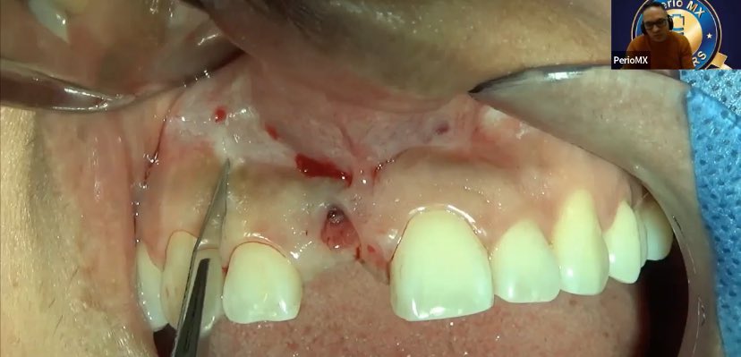 PerioMX's tweet image. En un implante, la descarga tiene que realizarse a uno o dos dientes contiguos
#incisiones #cursoPerioMX #PerioMembers #implantes