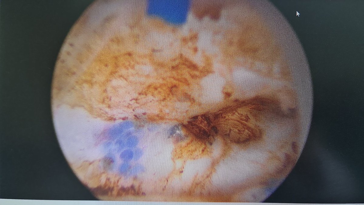 Teodoro Di Capua (@teodicapua) on Twitter photo During aeep for 198g prostate are seen this blue dots everywhere in prostatic capsule 🤔🤔... then remembered prostatic embolization 5 years ago.
It looks not so useful than described in papers. What U think?
<a href="/quanta_system/">Quanta Surgery</a>
<a href="/fgomsan/">Fernando GomezSancha</a> <a href="/trwherrmann/">Thomas RW Herrmann</a> <a href="/ThiagoHotaUro/">Thiago Hota</a> <a href="/FCAFigueiredo/">Felipe Figueiredo HoLEP 🇧🇷</a> During aeep for 198g prostate are seen this blue dots everywhere in prostatic capsule 🤔🤔... then remembered prostatic embolization 5 years ago.
It looks not so useful than described in papers. What U think?
<a href="/quanta_system/">Quanta Surgery</a>
<a href="/fgomsan/">Fernando GomezSancha</a> <a href="/trwherrmann/">Thomas RW Herrmann</a> <a href="/ThiagoHotaUro/">Thiago Hota</a> <a href="/FCAFigueiredo/">Felipe Figueiredo HoLEP 🇧🇷</a>