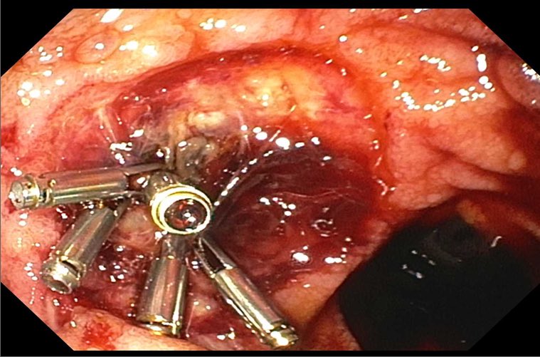 “That’s not bleeding. THIS is bleeding!” My Saturday AM 🤷🏽‍♂️ @GIDrDon @stevenbollipo @drkeithsiau @AllonKahn @DrBloodandGuts @tberzin @DouglasAdlerMD @PerelmansPearls @GI_Pearls @DrHarryThomas @DrReddyGI @BrennanSpiegel @AustinChiangMD @AmCollegeGastro #GITwitter @ASGEendoscopy