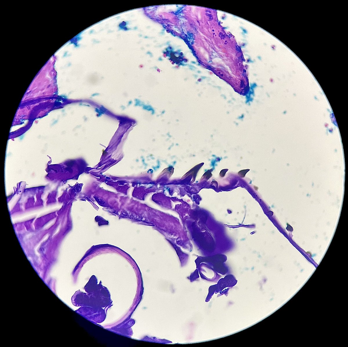 Male, 37 yo, ulcer on the right hand and… something seems to be moving. Knock knock who’s there? 👀 

PS: The horns are the clue 🔎

#CrittersOnTwitter #pathart #dermpath #dermpath #pathresidents #pathology #path