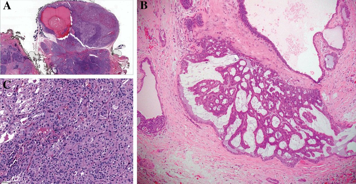 Peter Sadow, MD, PhD (@pathdocboston) on Twitter photo Prepping for the <a href="/NASHNPath/">North American Society of Head & Neck Pathology</a> session at <a href="/TheUSCAP/">USCAP</a>? Let Dr. Katabi from <a href="/MSKPathology/">MSK Department of Pathology & Laboratory Medicine</a> prep you with oncocytoid salivary neoplasia! rdcu.be/dCfh5 #MSKCC #USCAP2024 #ENTPath Prepping for the <a href="/NASHNPath/">North American Society of Head & Neck Pathology</a> session at <a href="/TheUSCAP/">USCAP</a>? Let Dr. Katabi from <a href="/MSKPathology/">MSK Department of Pathology & Laboratory Medicine</a> prep you with oncocytoid salivary neoplasia! rdcu.be/dCfh5 #MSKCC #USCAP2024 #ENTPath