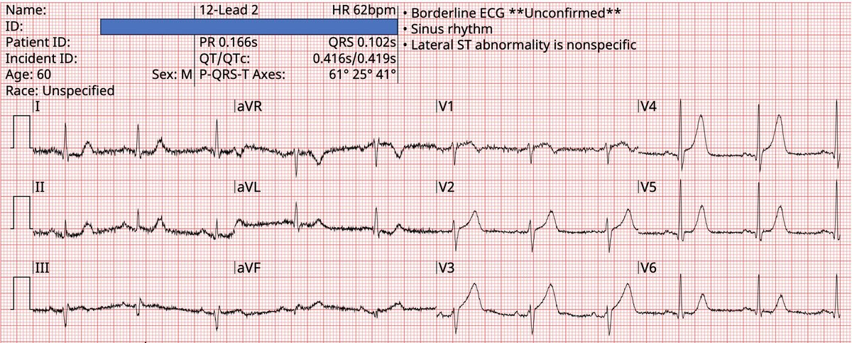 Kudos to colleagues <a href="/rmenonmd/">Rohit Menon</a> and @LeenAlblaihed, quick activation of cath lab on this prehospital ECG led to stents of occluded LAD and 2nd diag; no computer, no AI...just sound knowledge of electrocardiography still saves lives! <a href="/UMEmergencyMed/">U of Maryland Emergency Med</a> <a href="/UMEMresidency/">UMEM Residency</a> #FOAMed
