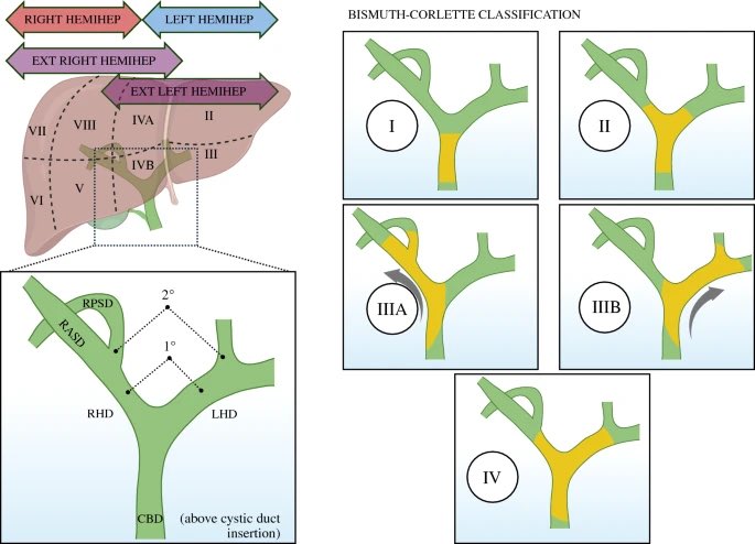 Major hepatectomy for perihilar cholangio-ca: should we be taking sides? My invited comment in @AnnSurgOncol : link.springer.com/article/10.124… on the large study by the Perihilar CCA Collaboration Group: doi.org/10.1245/s10434…. @hpb_so