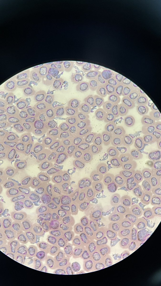 Thin blood smear after enrichment with Histodenz from a P. vivax-infected patient showing trophozoites and gametocytes. #malaria #parasite #parasitology #science