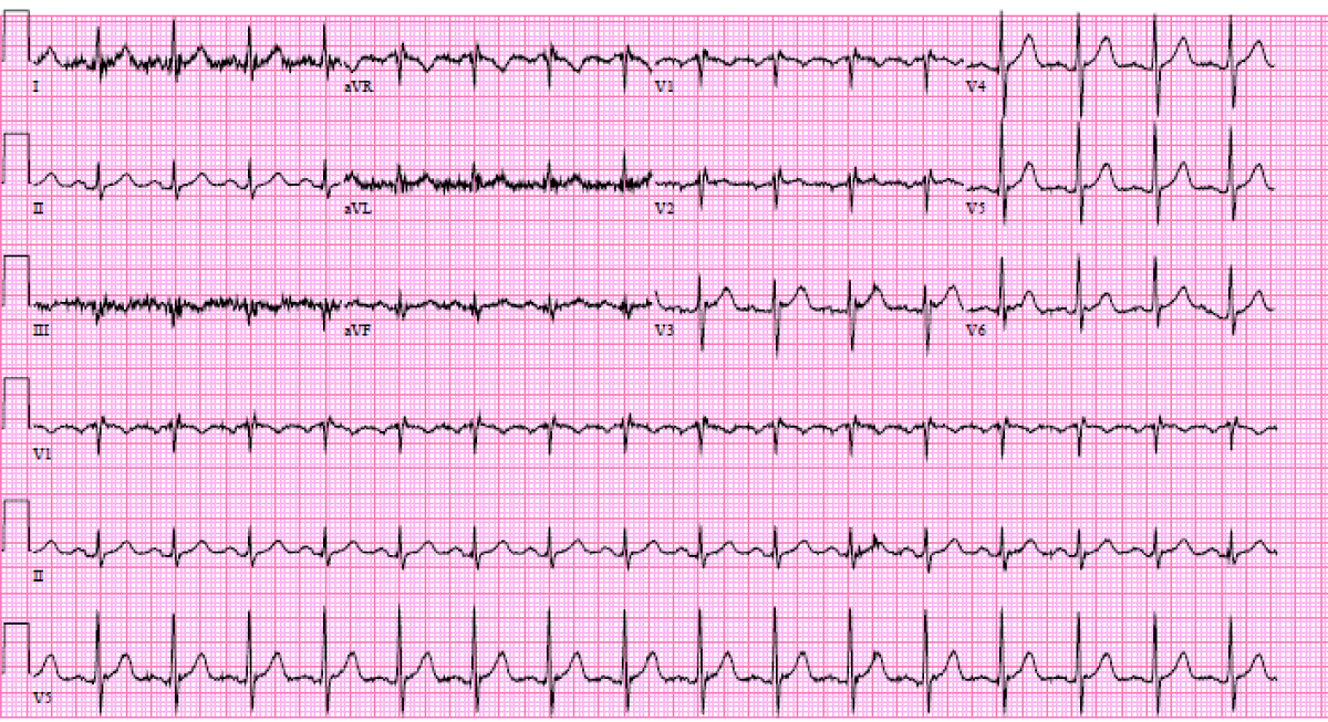 38 year old presents with this ECG, defibrillated in the field, although was in that rhythm (205 bpm) for 2 hours. Normal structural heart. Thoughts? In any job there is the easy stuff, and there is the stuff that keeps it exciting.