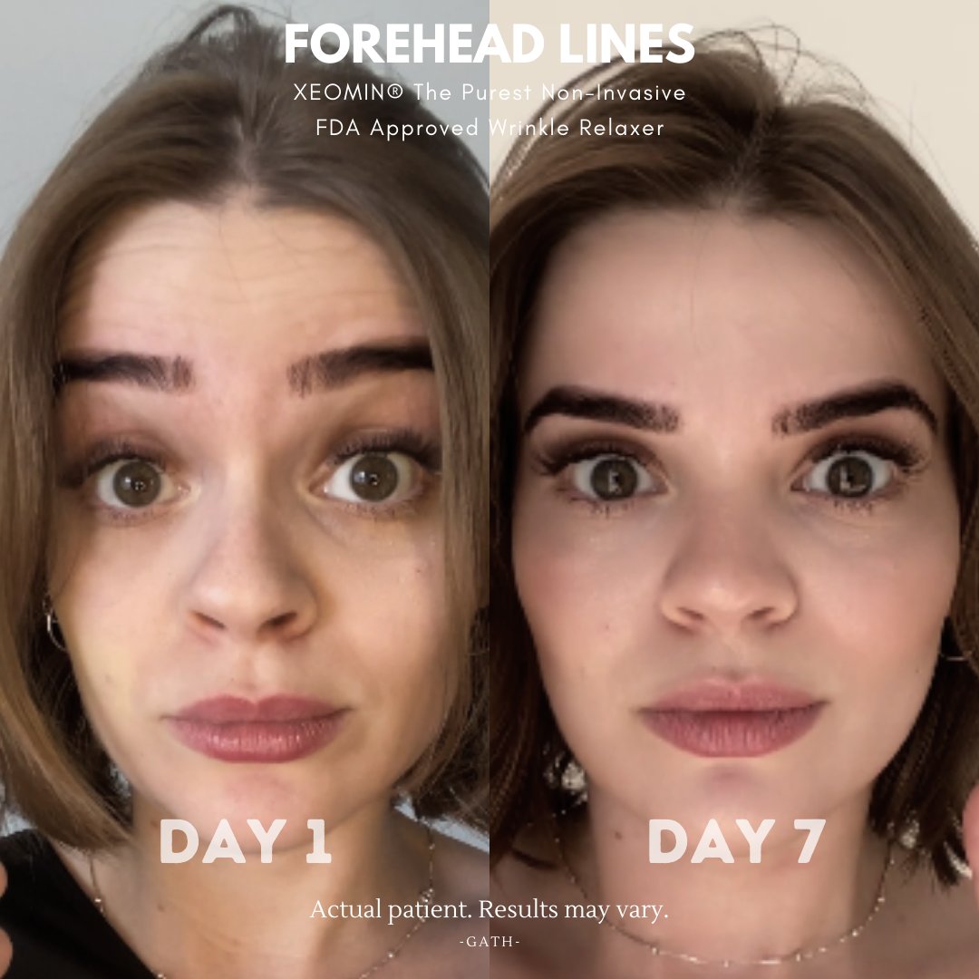 medspaofhouston's tweet photo. "Smart Toxin" is purer wrinkle relaxer that gives visible results in 7 days.😍✨
$99 for one area (20 units)
Over 200,000 units used in the 7 Day Anti-wrinkle Challenge.
#Smarttox #Smarttoxin #MedspaOfHouston #Medspa #injectables #Houston #beforeandafter https://t.co/fcUlEfUA1d