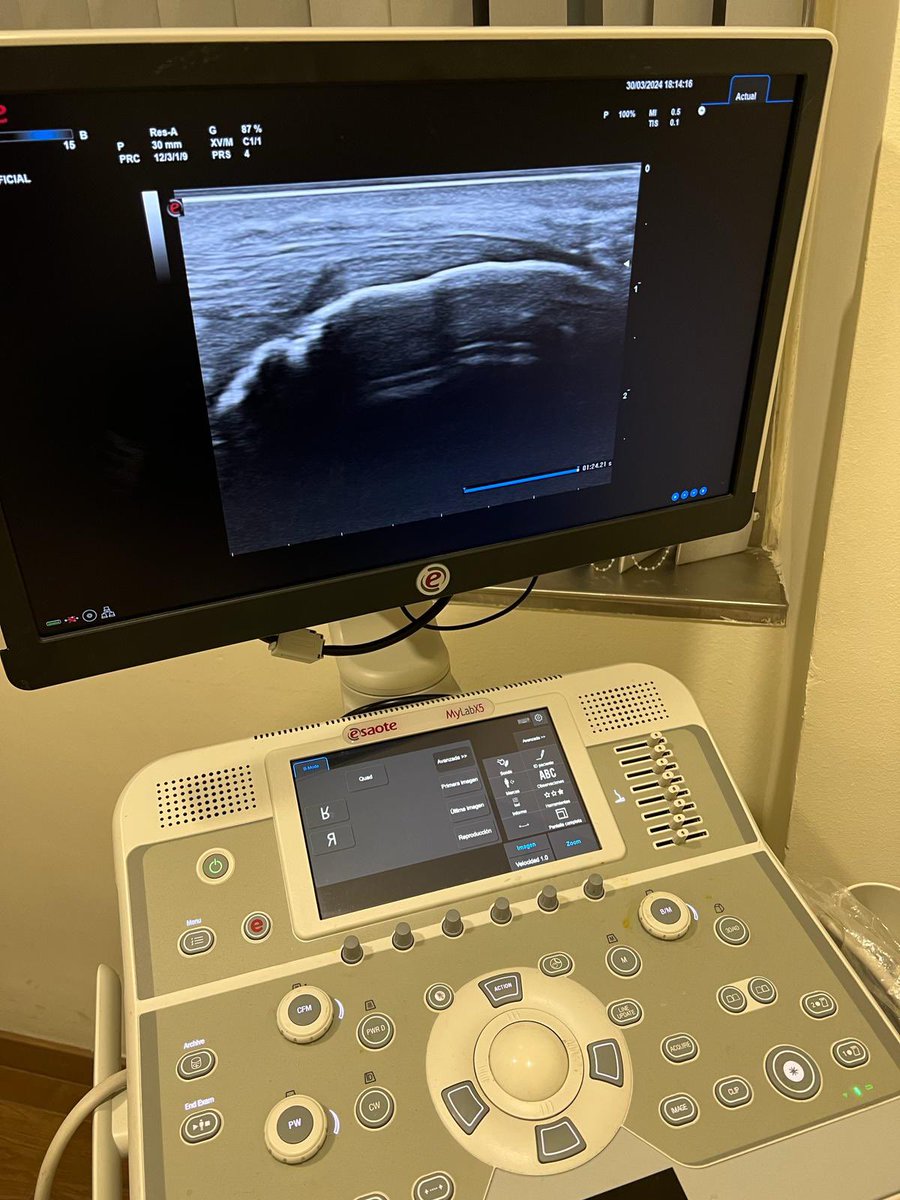 MarioMirabel's tweet image. Se acabó para mí la primera parte de la temporada 2024. 

🤕Rotura parcial del Aquiles insercional. 

@Capa1973 me infiltra con PRP y en 15 días veremos evolución. Si no es la esperada, igual toca pasar de nuevo por quirófano. 

Tengo claro que volveré a correr, como sea