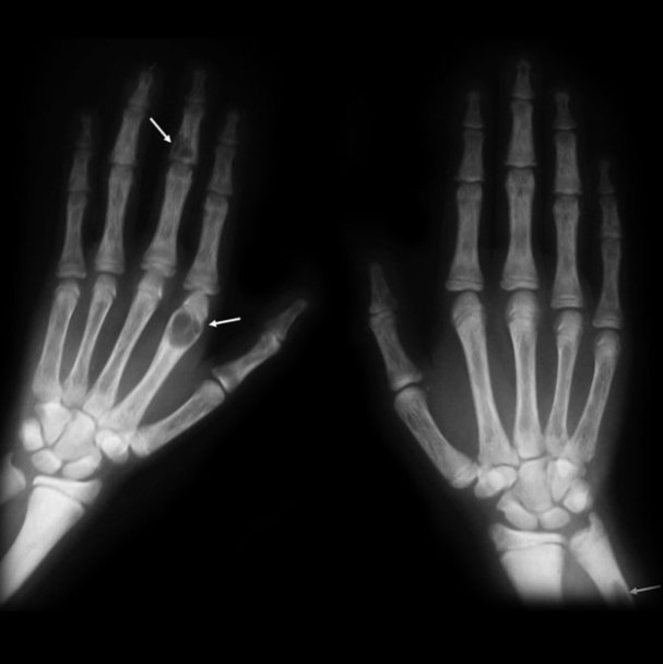 70/M backache, hypertensive,pain in hand joints, creatinine 3.8mg/dl. Xray hands done. Serum Calcium Normal, High P and PTH. Diagnosis, Differential diagnosis? #Rheumtwitter #Medtwitter