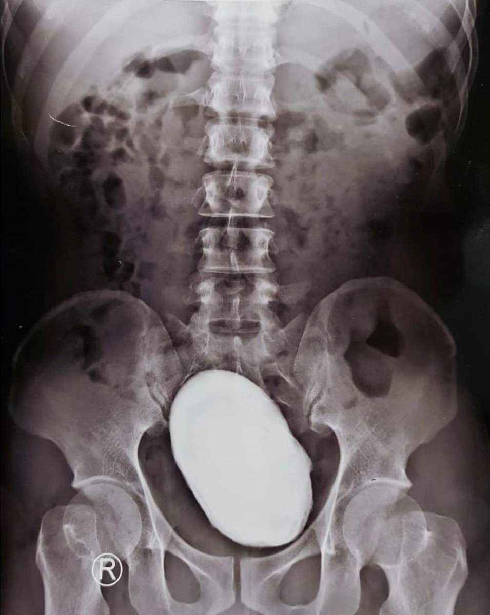 32M with lower abdominal pain and recurrent urinary tract infections. What’s the diagnosis?