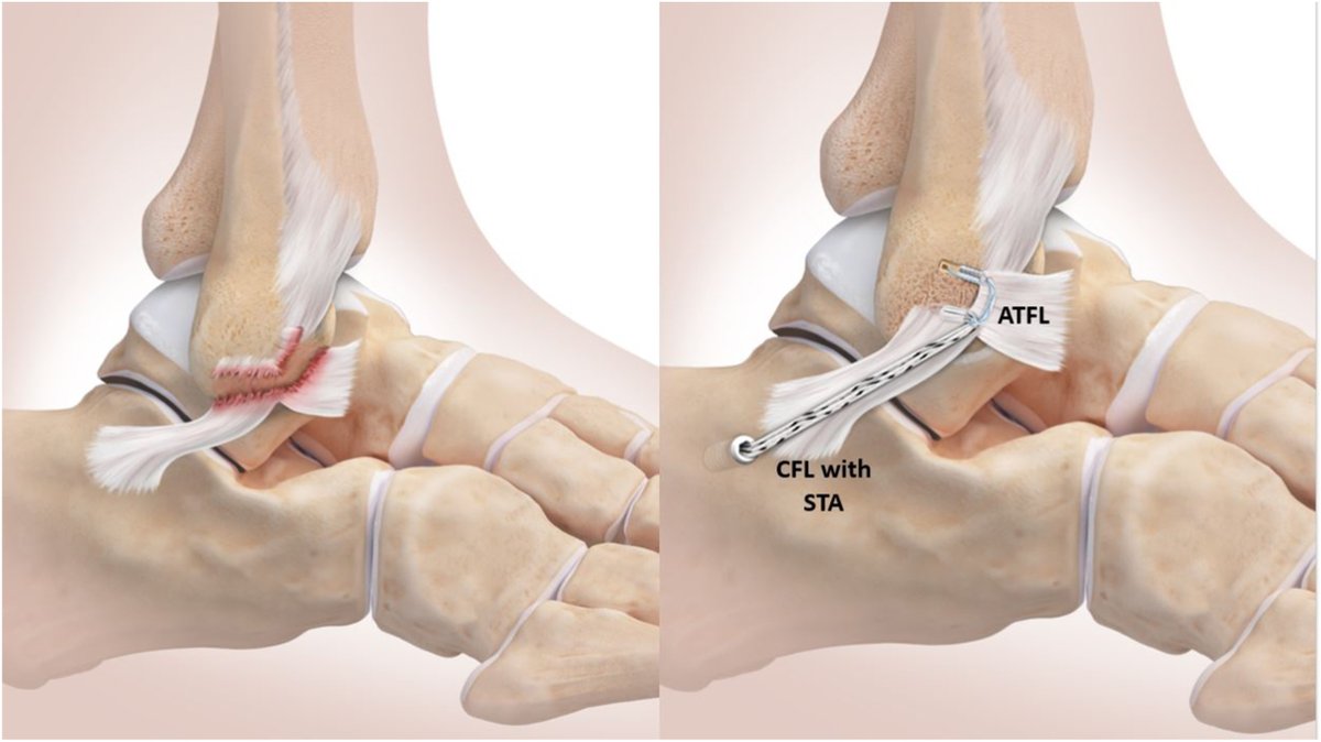 Arthroscopic Modified Broström Repair with Suture-Tape Augmentation of the CFL for Lateral Ankle Instability #ankle #arthroscopy #instability arthroscopytechniques.org/article/S2212-…