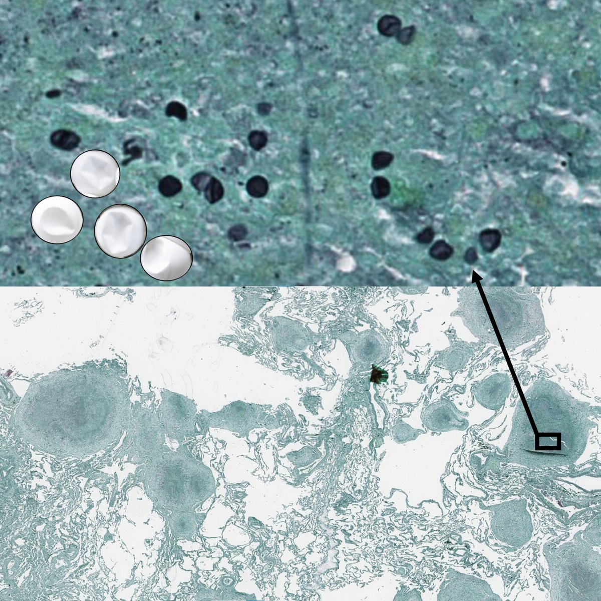 Which fungus🍄 = crushed🏓⚪️?
A) Pneumocystis
B) Blastomyces
C) Cryptococcus
D) Coccidioides
🖼️🙏Dr. Carol Farver
#CrittersOnTwitter #PathBugs #PathTwitter #PathResidents #PulmPath