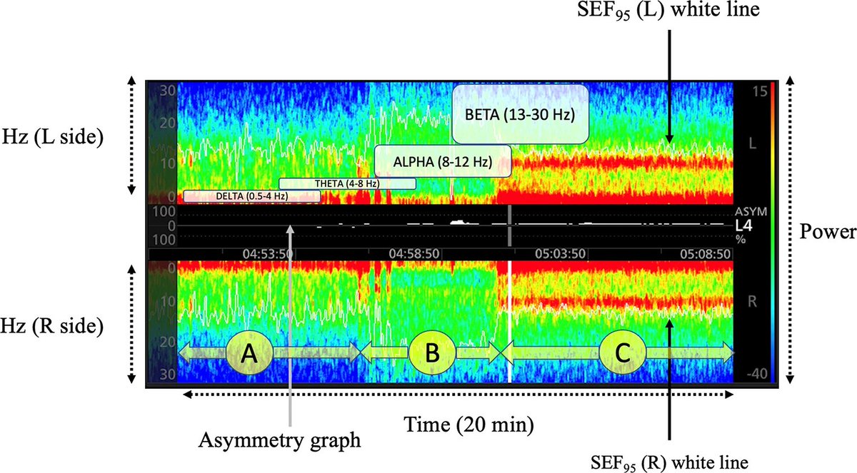 JcmcSoMe's tweet photo. Non-invasive technology for 🧠 monitoring: definition and meaning of the principal parameters for the International PRactice On TEChnology neuro-moniToring group (I-PROTECT)

 @StefanoRomagno9 , @francisco_alobo , @FrankRasulo , @chiara_robba , @drbmatta 

https://t.co/frVj9VLJDf https://t.co/kbesoAOch3