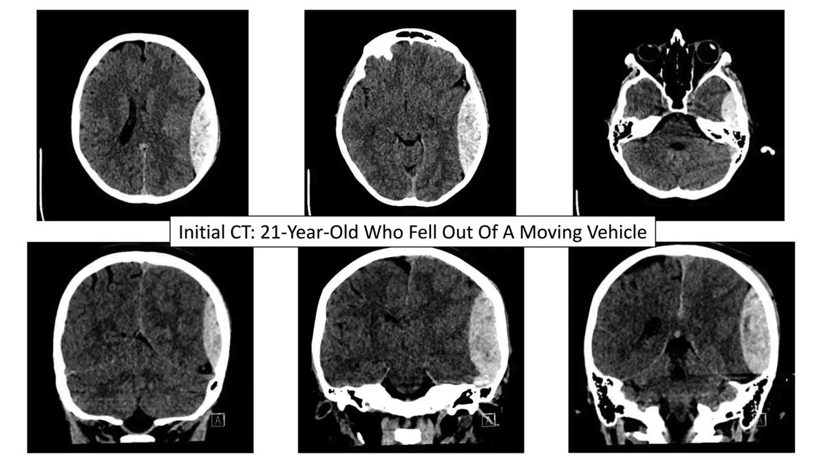 Dive into our latest Neuroimaging Cases installment focusing on Epidural Hematomas. litfl.com/neuroimaging-c… #MedEd #MedTwitter #FOAMed #Radiology