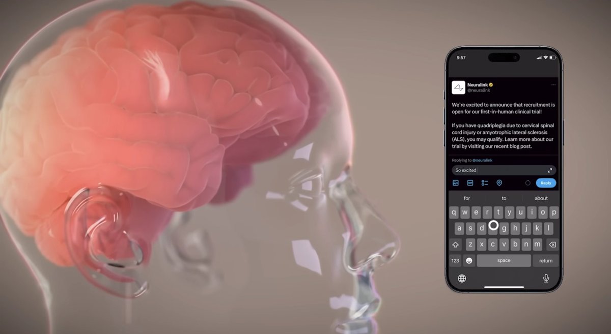 Neuralink's Brain Chip Implant: The first human patient, 'P1' danielkjung.com/tech/neuralink…