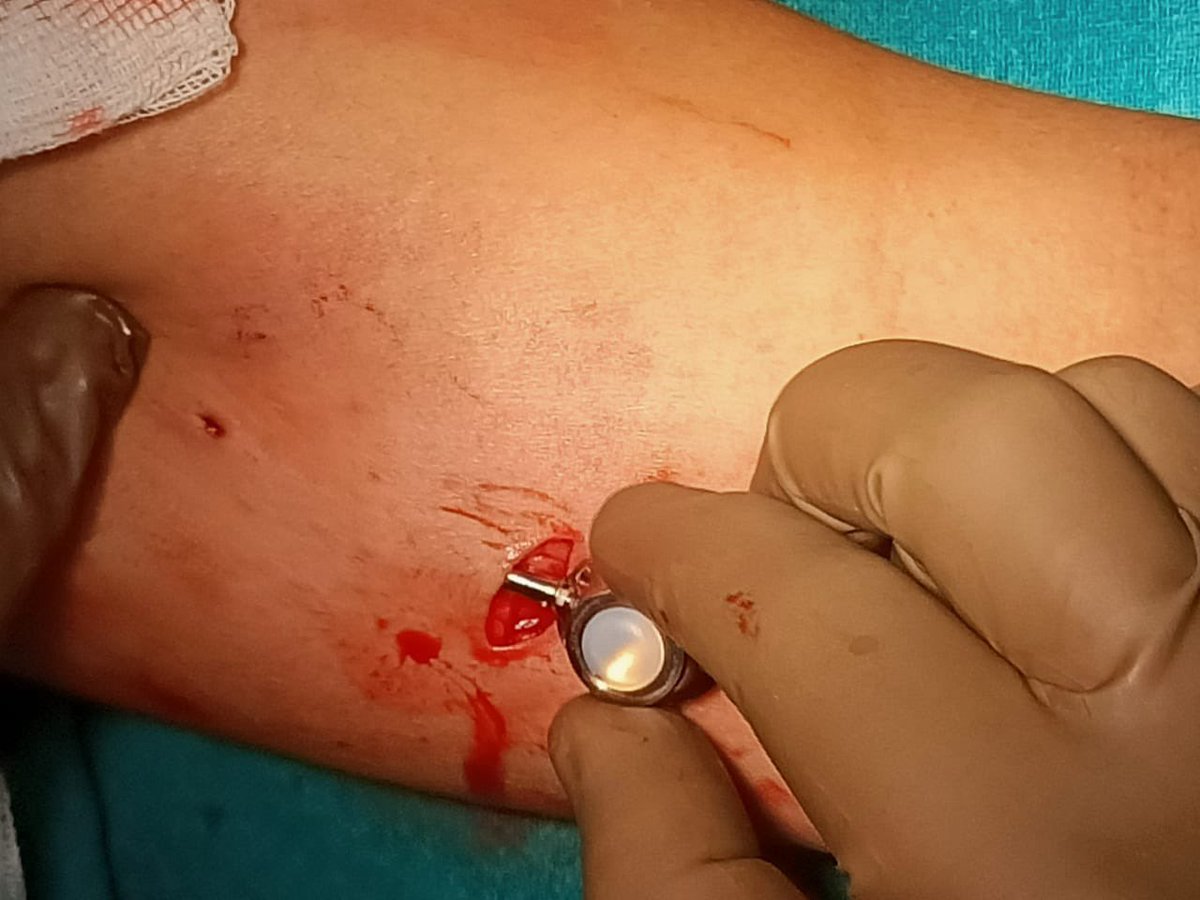 bharatgupta300's tweet photo. PICC-PORT revolution
A new way of long term VAD in oncology patients.
It’s gaining ground as the preferred mode of venous access around the world.
Implanting it since last 6 months.
Benefits of both PICC and PORT comes in bundle. #GAVeCeLT #WoCoVa #PICCPORT #sergio #Plan1Health https://t.co/KZyzOT7dyf