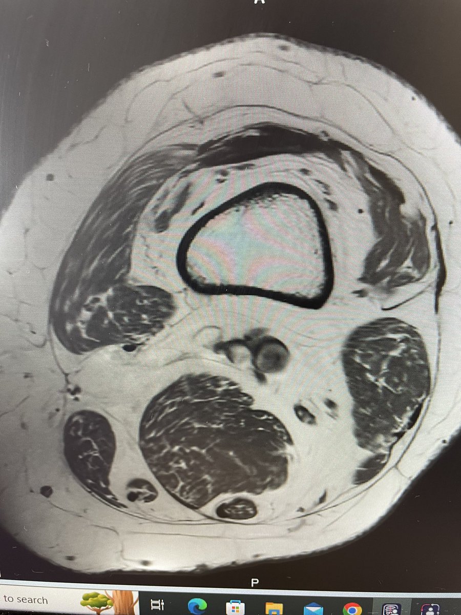 Howard Luks MD (@hjluks) on Twitter photo The distal thigh of a 40 something. 
Imagine losing this much muscle mass already and being able to remain active into your 70s and beyond. It should be very hard to imagine. Because they won’t be. The distal thigh of a 40 something. 
Imagine losing this much muscle mass already and being able to remain active into your 70s and beyond. It should be very hard to imagine. Because they won’t be.