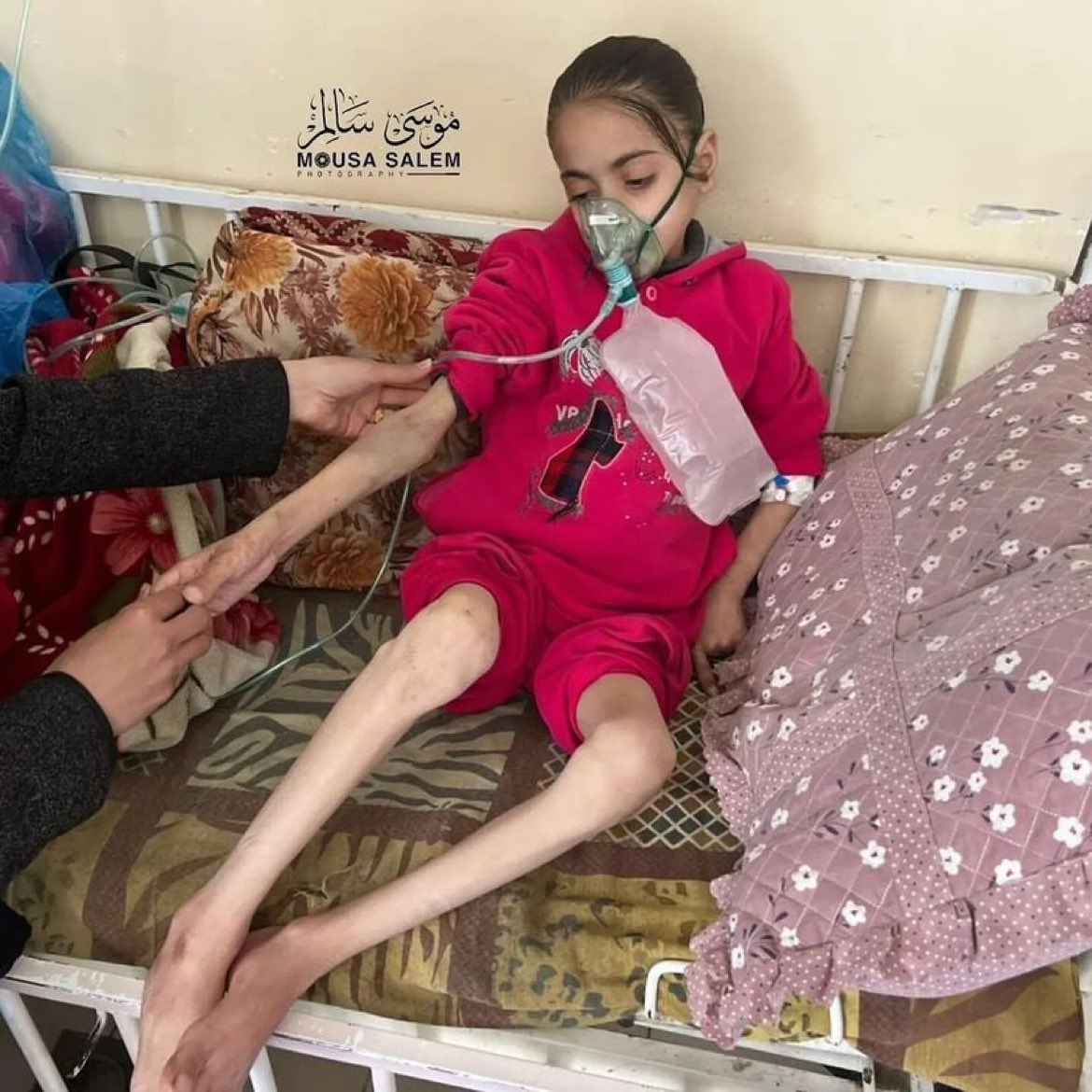 DrLoupis's tweet image. Palestinian child Nour Al-Huda is in a life threatening condition from malnutrition due to the Israeli deliberate blockade of aid to Gaza.
