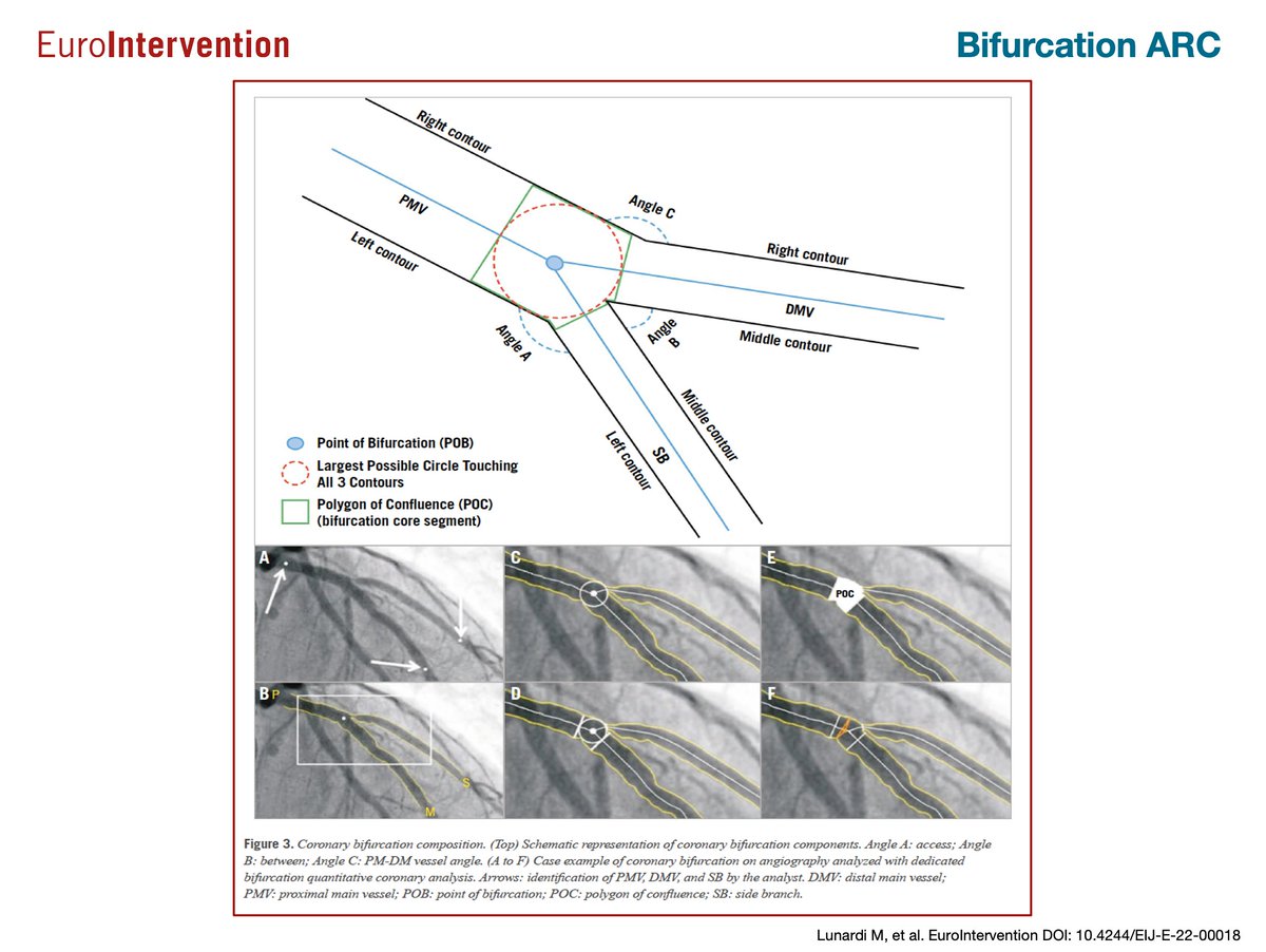This consensus provides standardized definitions for bifurcation lesions; the criteria to judge the side branch relevance; the procedural, mechanistic, and clinical endpoints for every type of bifurcation study; and the follow-up methods. Considering the complexity of bifurcation…