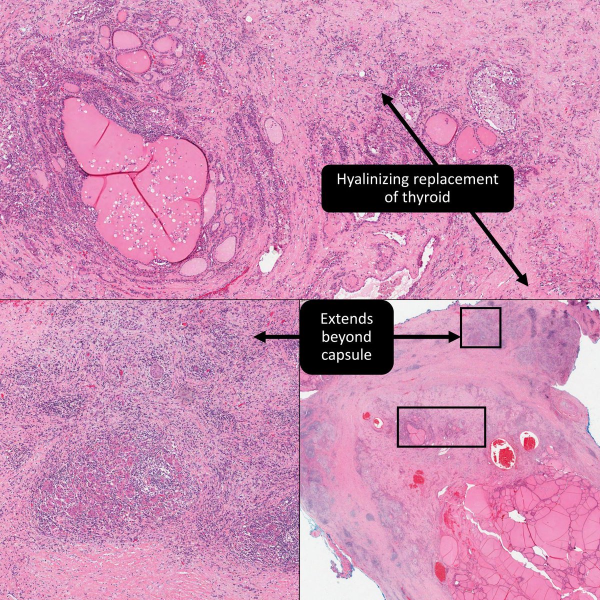 Thyroid, diagnosis?
A) Hashimoto Thyroiditis, Fibrosing Variant
B) Reidel Thyroiditis
C) Diffuse Sclerosing Variant of PTC
#ENTPath #EndoPath #PathResidents #PathTwitter #Thyroid #BSTPath
🔬
virtualpathology.leeds.ac.uk/slides/library…