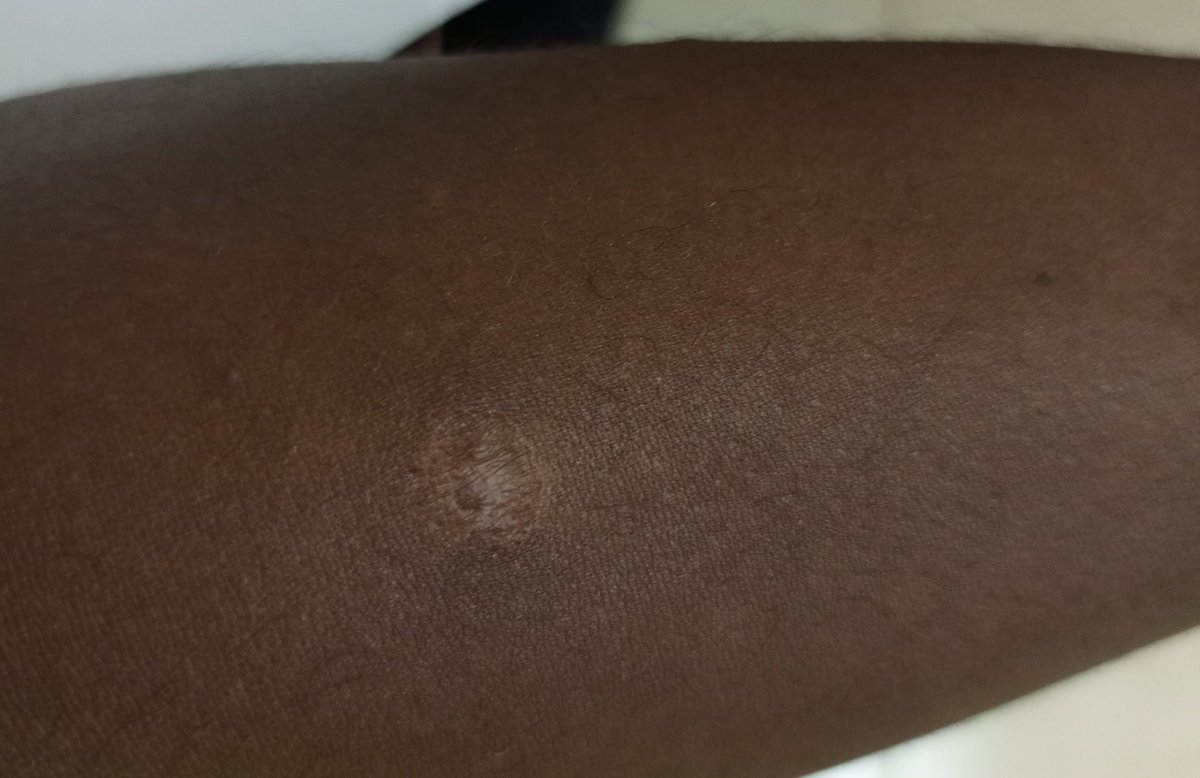 The BCG vaccine given at birth does not prevent INFECTION with Tuberculosis. However, it prevents severe forms of Tuberculosis such as TB meningitis and Miliary TB. Even with the chanjo, learn to protect yourself.
Here's a BCG vaccine scar.
#WorldTuberculosisDay