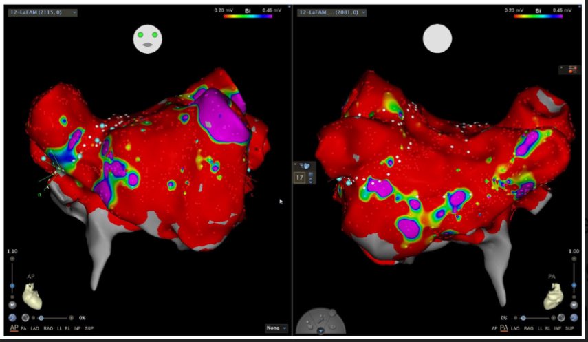 ⚡️Arrhythmias in PH & RV Failure: Importance of Rhythm Control mdpi.com/2725650 #mdpijcm via @JCM_MDPI Important paper from @TempleHealth @TempleCards Advanced🫀#PulmonaryHypertension /PVD Fellow, Suneesh Anand & ⚡️ @dredcronin #EPEEPS #AVsynchrony #PeoplesVentricle