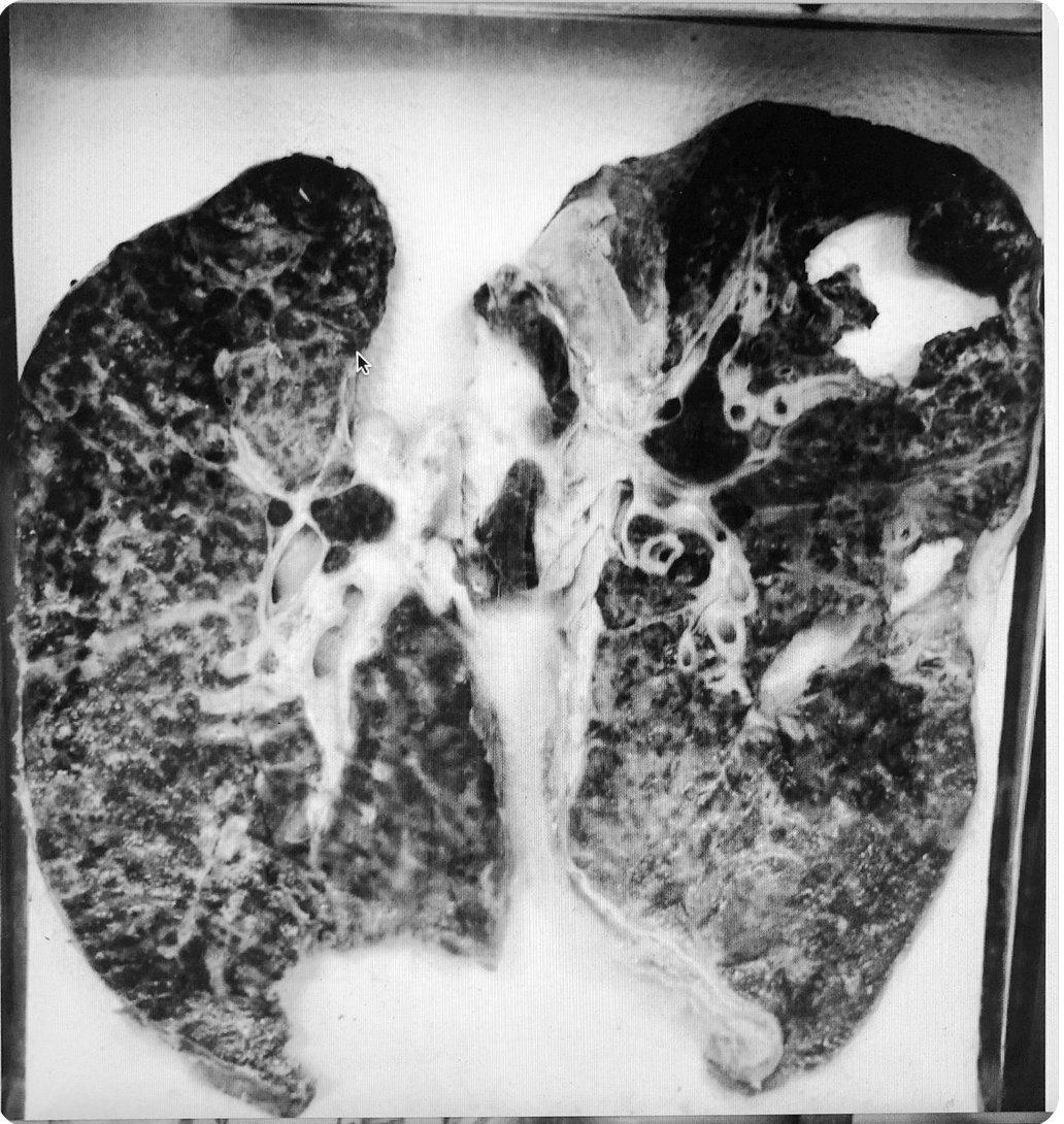 MariaSmilios's tweet photo. It’s #WorldTBday 2024 &amp; no one‘s lungs should look like this!

Let's #EndTB by ending health inequities &amp; demanding affordable &amp; accessible drugs

👉@DanaherCorp 👀 at you

@cdmitpih @johngreen @NftwtAgainstTB @GlobalTB
@paimadhu @goodgoodgood @Sheila_DavisDNP @PIH @johngreen https://t.co/oE6enbIw0y