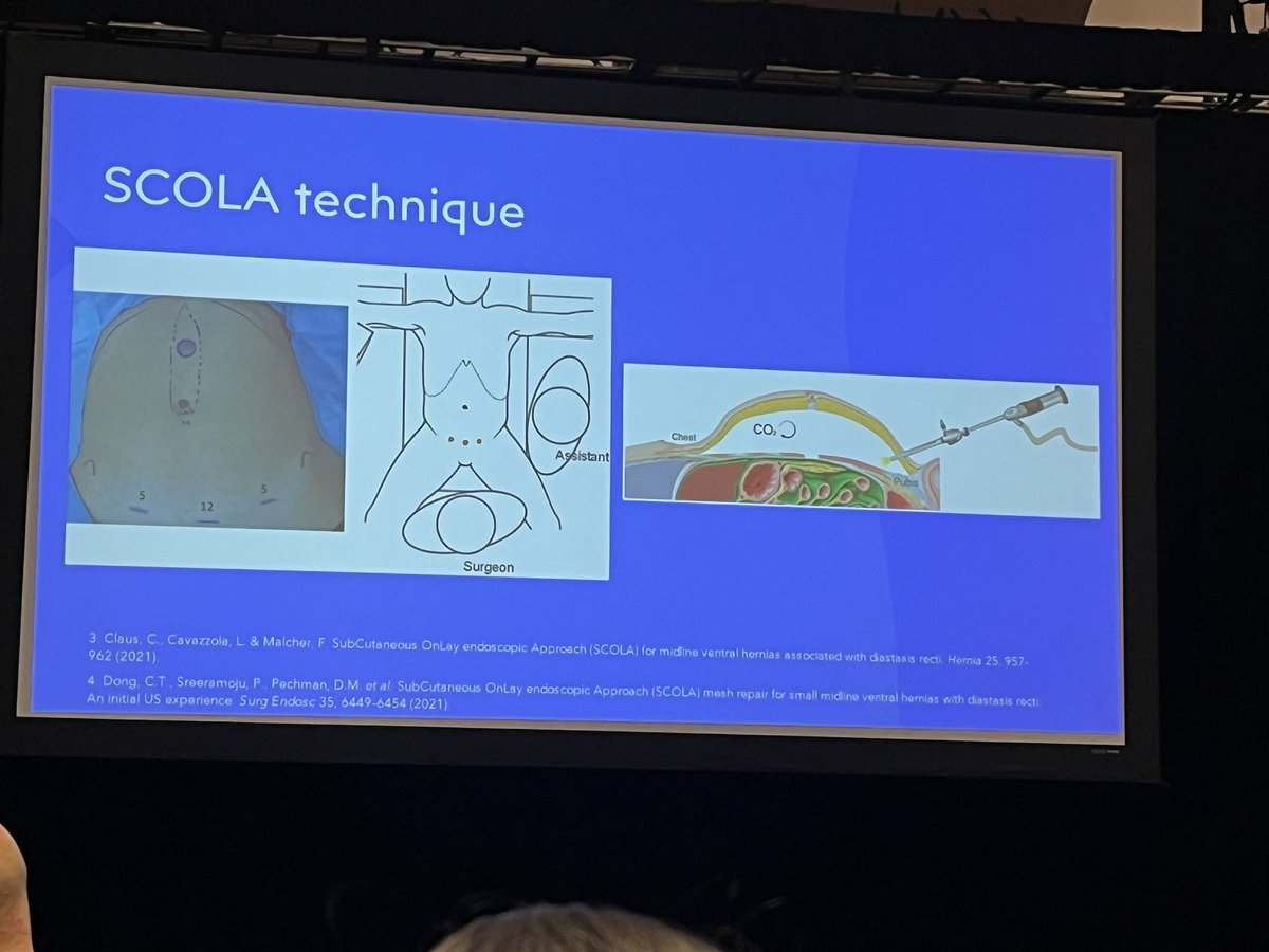 Trends in VHR coming at you next! Starting off with a nice discussion of the SCOLA technique. #ACHQCQISummit24