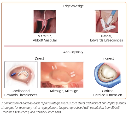 📜@CardioNerds #USCardiology Article Alert‼️ 'Secondary Mitral Regurgitation: Diagnosis and Management' by Dhaduk, Ibrahim, et al. 🔗uscjournal.com/articles/secon…