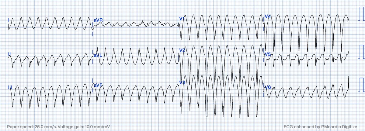 Palpitations and presyncope in a 40-something hqmeded-ecg.blogspot.com/2024/03/palpit…