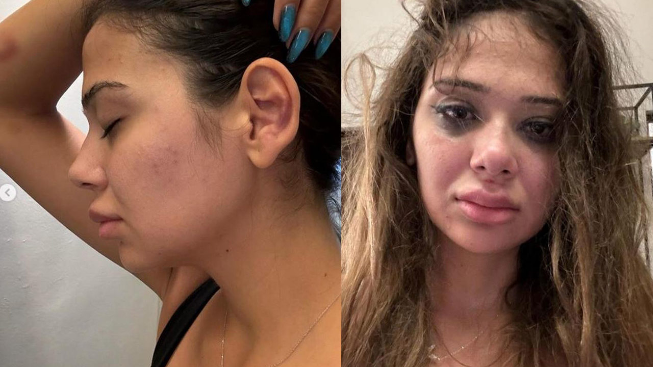 Odatv on X: Onlyfans fenomeni Merve Taşkın sevgilisinden gördüğü şiddeti  paylaştı: Kafamı, kulağımı, burnumu yumrukluyor, karnıma, cinsel organıma  tekme atıyordu. Bazen ise beni öldürmekle ya da sakat bırakmakla tehdit  ediyordu t.coFtCrKodc2I ...