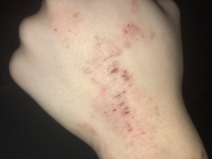 重症で草
暇だし皮膚科行くか〜
今空いている皮膚科探すか〜
ないか〜
ゆるさない😡 