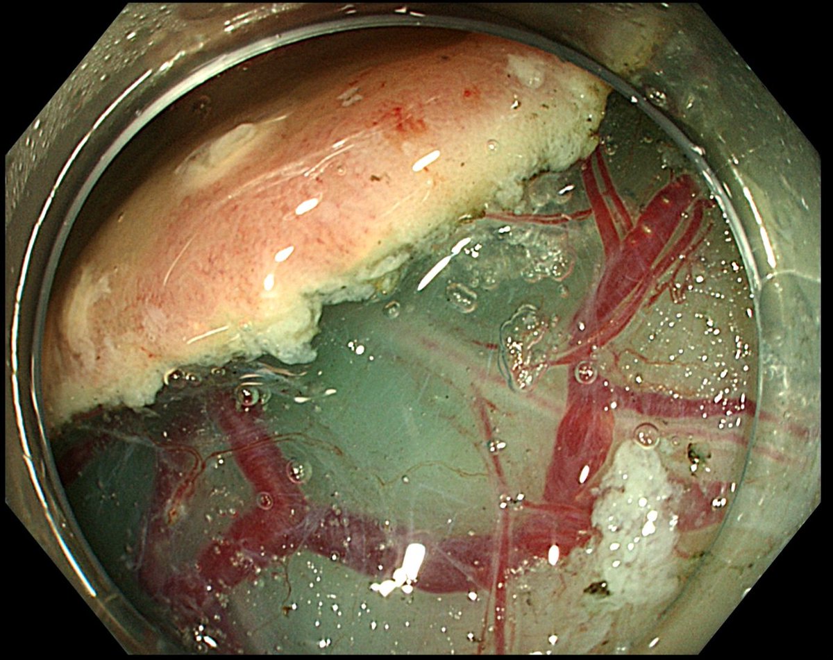 🔵 I literally love #ESD... 🥰

💫 @drmanmeetm @AnaDugic @ElenaSantosP @ikaraujoa @AriBensonMD @drkeithsiau @MarcusHollenba1 @RobValente83 @iangralnek 💫 #SoMe #MedTwitter @ArchibugiLivia @NEndoscopy @AEMLondon @lauraa_lexandra @WomeninEndo 
#myUEGcommunity 🔵