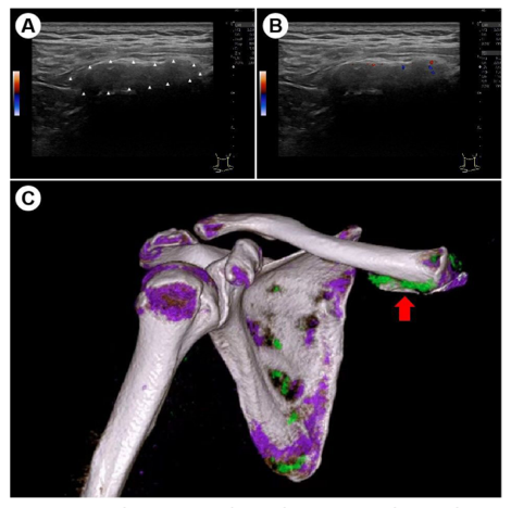 eular_ARD's tweet photo. 🔍After indulging in beer 🍺, a bus driver 🚌 faces unusual symptoms: 
pain in just the sternoclavicular joint, with normal labs but a high ESR. 

What's your diagnostic guess? 🕵️‍♀️ 
🖇️ https://t.co/Oqx5esBpI9
#MedicalMystery #HealthQuiz https://t.co/ERm83J1bfm