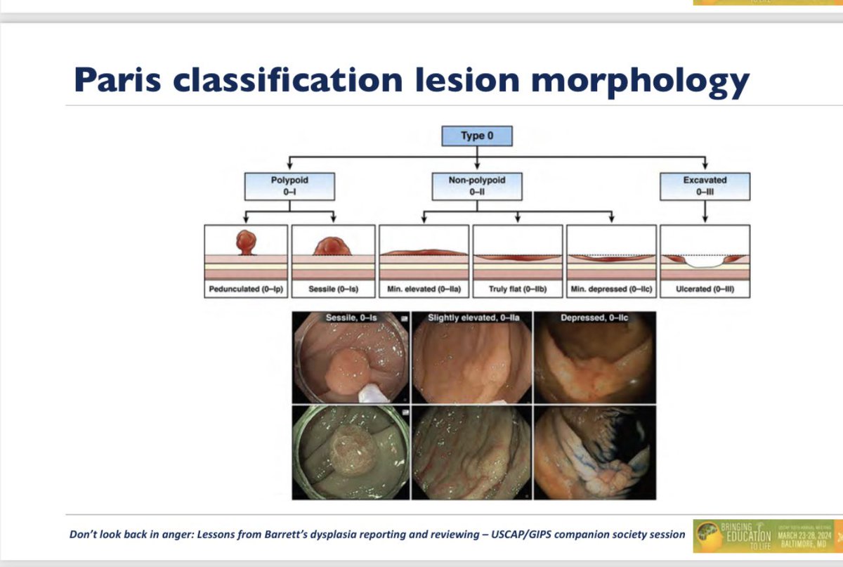 Endoscopy is key for Barrett evaluation: @USGIPS #USCAP2024