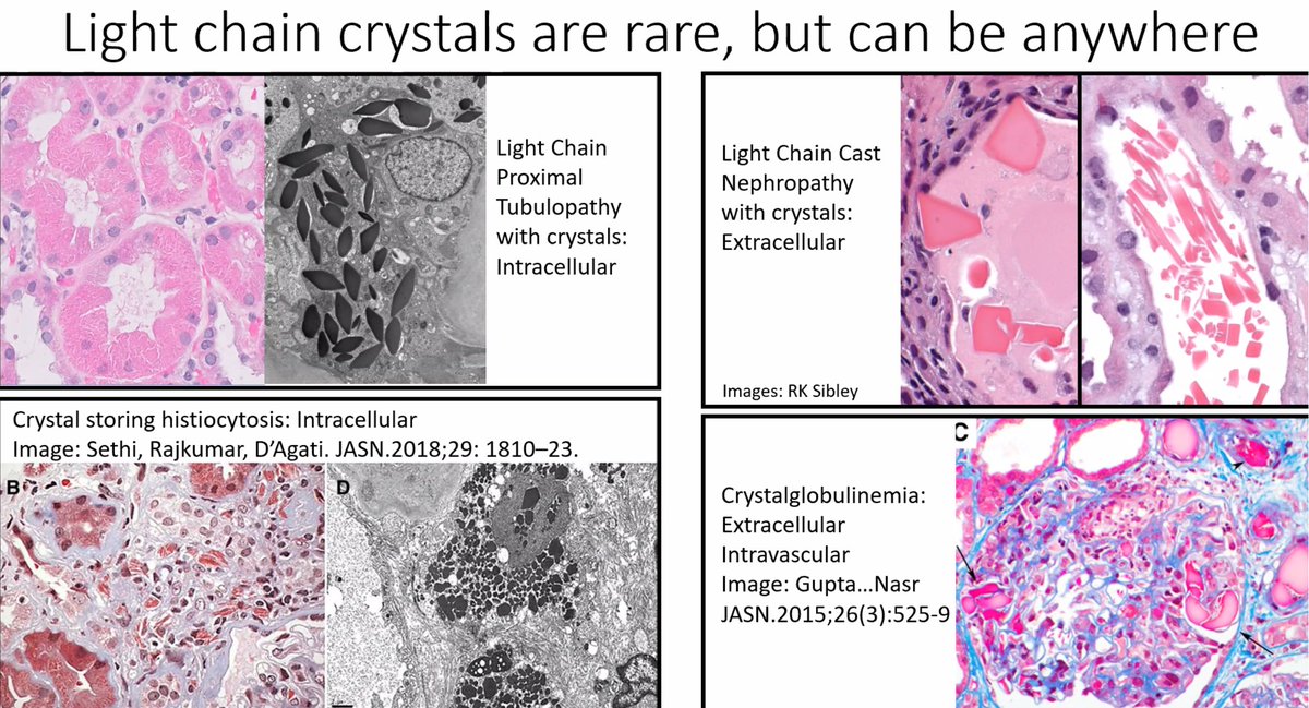 Light chain crystals can be seen in:
1. Tubules - LCPT
2. Casts - LCCN
3. Histiocytes - Crystal storing histiocytosis
4. Capillaries - Crystaloglobulinemia
5. Podocytes - Light chain crystalline podocytopathy
<a href="/Renalpathsoc/">Renal Pathology Society</a>