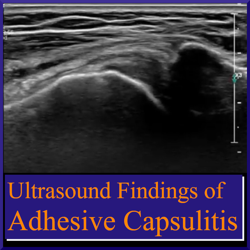 Dr. Rubin looks at the ultrasound findings in adhesive capsulitis! #sportsmed #sportsmedicine #medicine #sports #foamSM #MedEd #FOAMed #ortho #medtwitter #OrthoTwitter #TBT #TBThursday #athletictraining #physicaltherapy sportsmedreview.com/blog/ultrasoun…