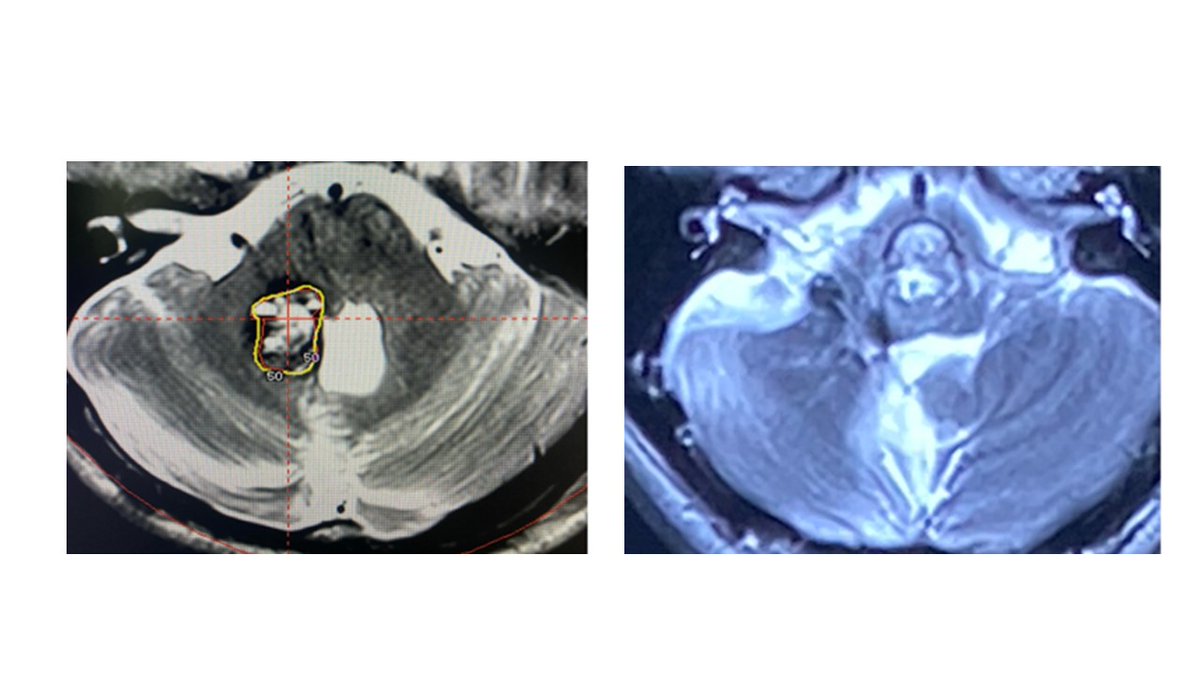 Pediatric cavernous malformation involving the brainstem and cerebellar peduncle at the time of Gamma Knife radiosurgery (left) and last follow up (right). Check out the latest report from my team in JNS Peds.