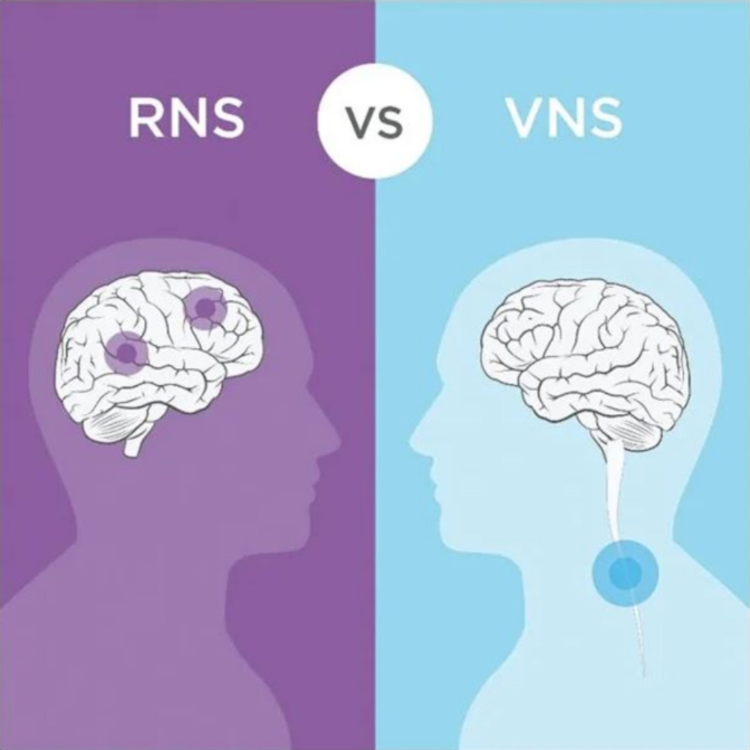 The RNS System and VNS Therapy are often confused with one another. One of the major differences is that VNS stimulates the vagus nerve while the RNS System stimulates at the #seizure source. 🧠 neuropace.com/patients/rns-v… Safety Info: neuropace.com/safety #epilepsy