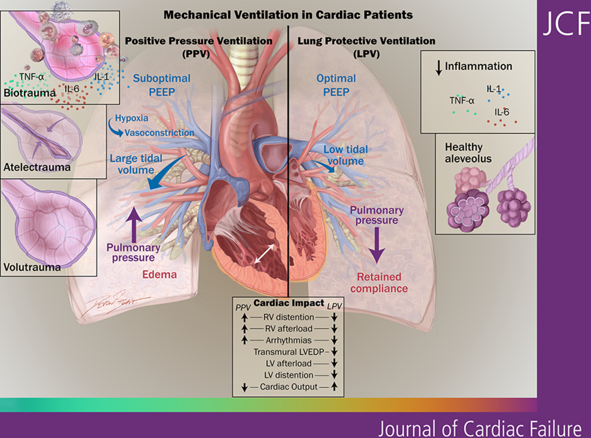 Guide to Lung Protective Ventilation in Cardiac Patients CCR Journal Watch criticalcarereviews.com/latest-evidenc… Get the latest critical care literature every weekend via the CCR Newsletter - subscribe at criticalcarereviews.com/newsletters/su…