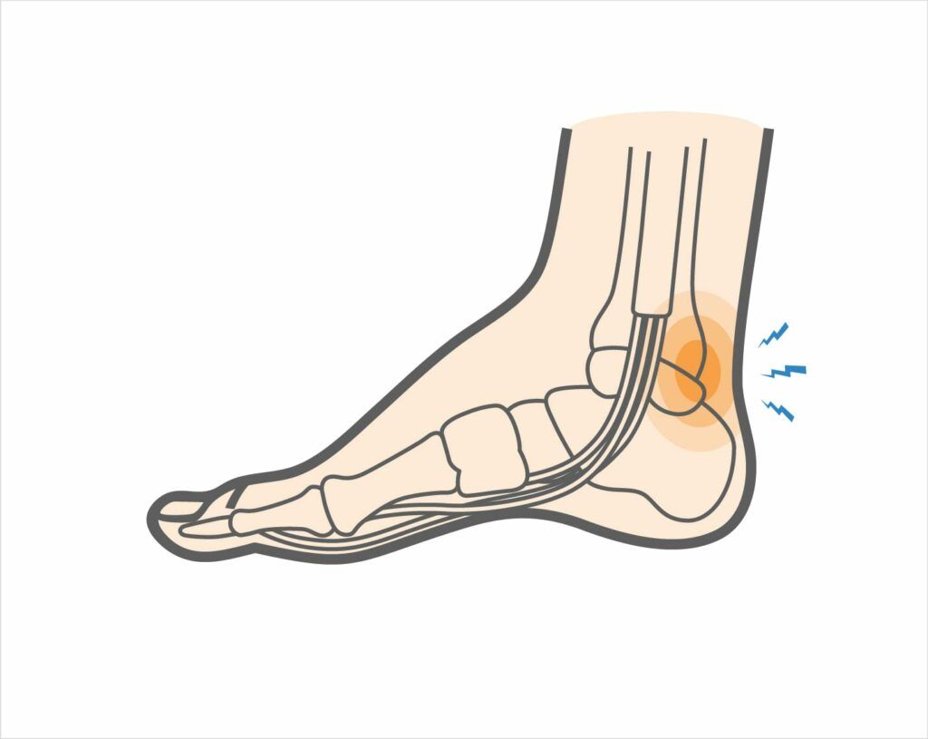 Posterior Impingement Sendromu ve Sporcularda Tedavi Yaklaşımı Ömer Yusuf Erdurmuş @omer_yusuf @acilci_net için yazdı, Ömer Yusuf Erdurmuş seslendirdi. buff.ly/3PANTJp #FOAMed