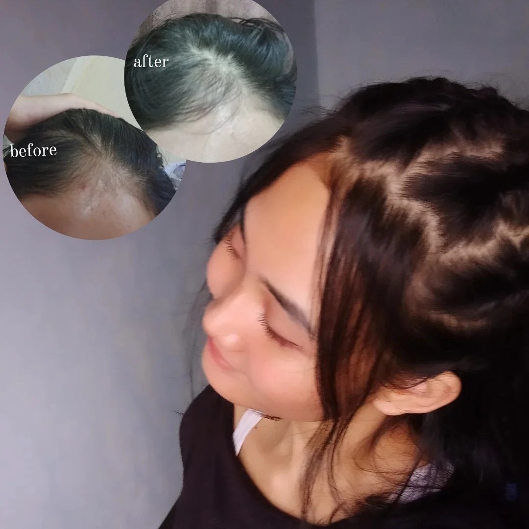 fidanzatav's tweet photo. suka hairstyle tapi keganggu karena rambut tipis sering sering rontok dan ngembang 

my struggles a few months ago.. sekarang aku udah bisa ngatasin rambut rontok dan mengembang 😬❤‍🔥 https://t.co/zmm36PAV41