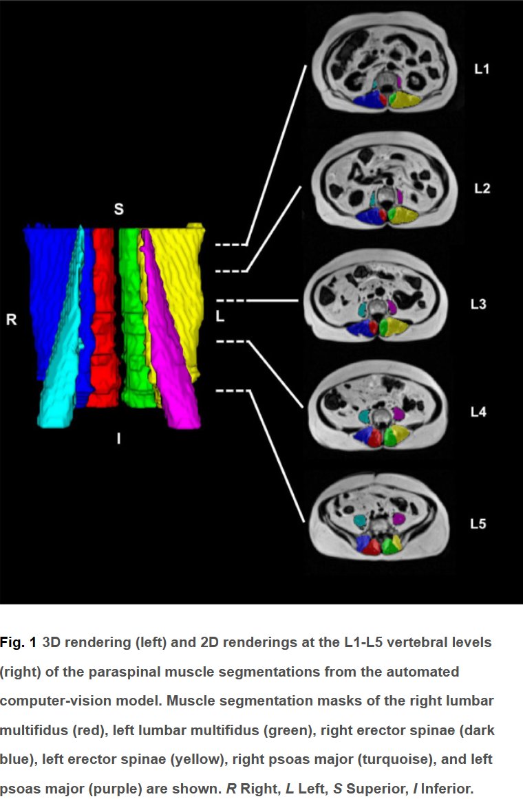 Dr. Sean Mackey (@drseanmackey) on Twitter photo Just published our latest findings from a comprehensive UK Biobank study: We've uncovered how lumbar paraspinal muscle health is intricately linked with age, BMI, sex, and physical activity levels. thespinejournalonline.com/article/S1529-… (free download - led by <a href="/EvertWesse45644/">Evert Wesseling</a> and <a href="/DrKenWeber/">Ken Weber, DC, PhD</a> ) Just published our latest findings from a comprehensive UK Biobank study: We've uncovered how lumbar paraspinal muscle health is intricately linked with age, BMI, sex, and physical activity levels. thespinejournalonline.com/article/S1529-… (free download - led by <a href="/EvertWesse45644/">Evert Wesseling</a> and <a href="/DrKenWeber/">Ken Weber, DC, PhD</a> )
