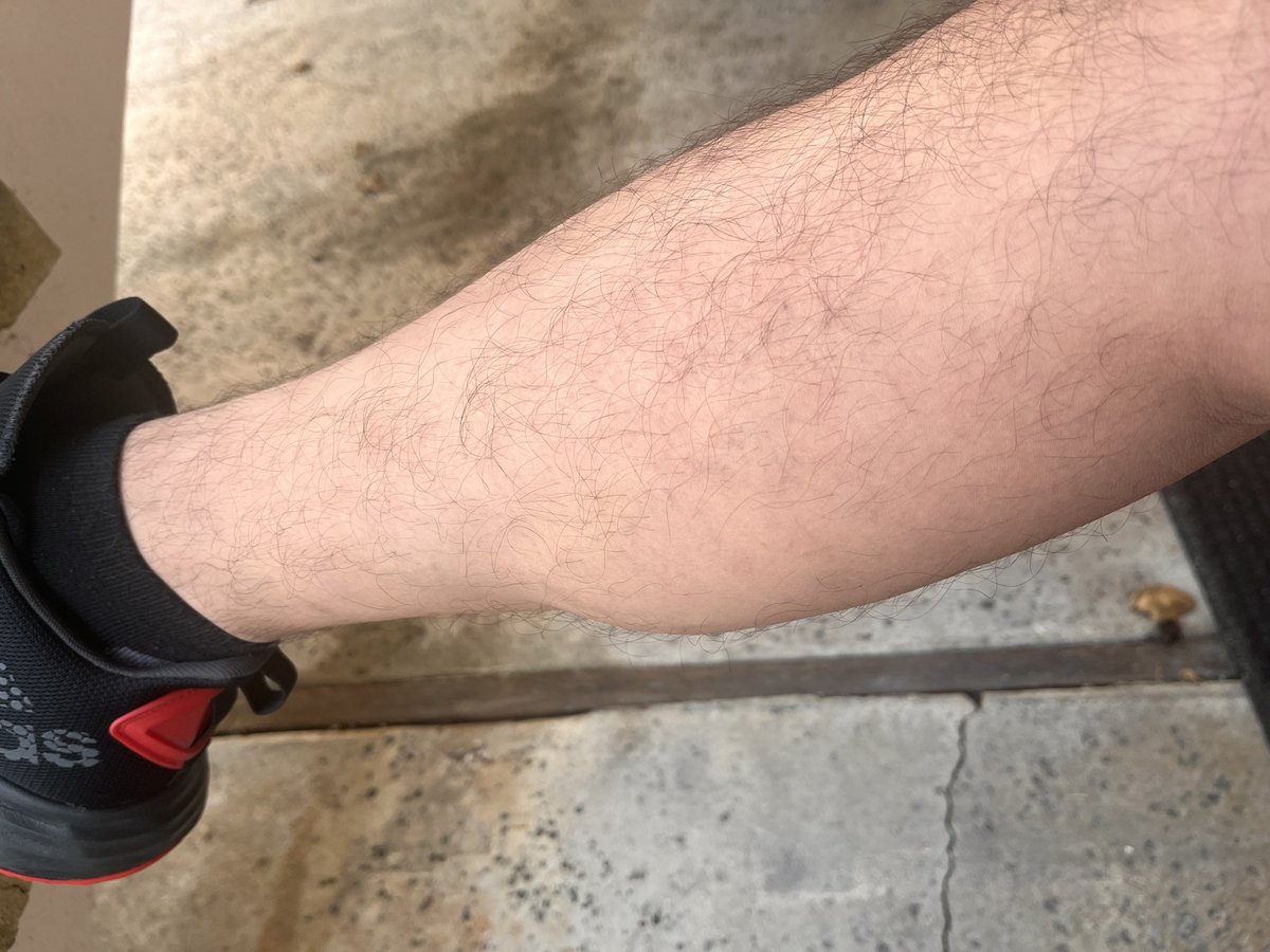 kirito7485's tweet photo. Amo el resultado después de mi cirugía (no más varices en mi pierna) / love the result after my surgery (no more varicose veins) https://t.co/GVO2MEEp86