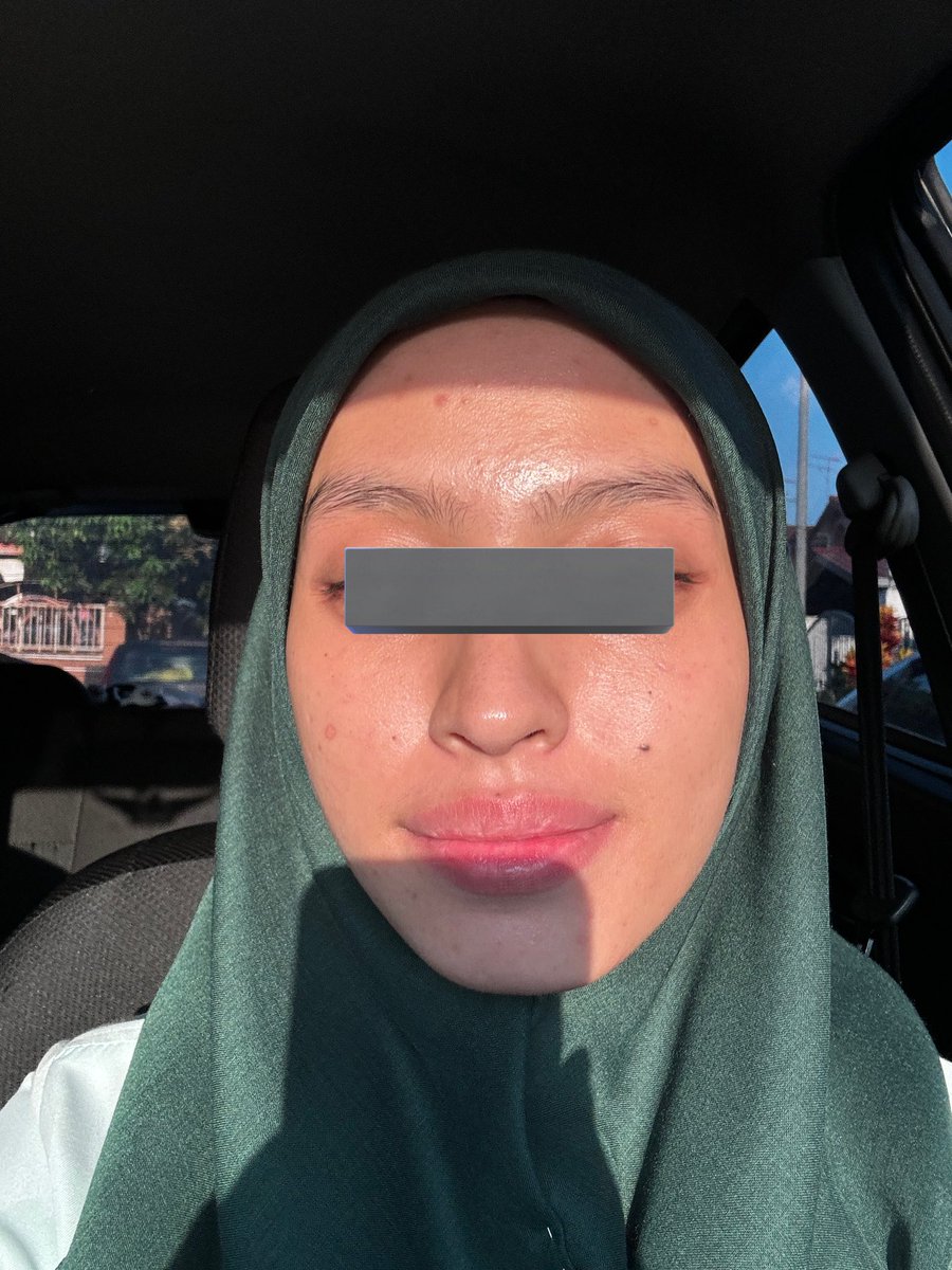 f_lowerz's tweet photo. Day 1 after treatment to day 7. Alhamdulillah kulit muka semakin baik even ada lg parut2 hitam. 
Next, kena kumpul duit buat pico laser 😂 https://t.co/2GtaXjgQ9l