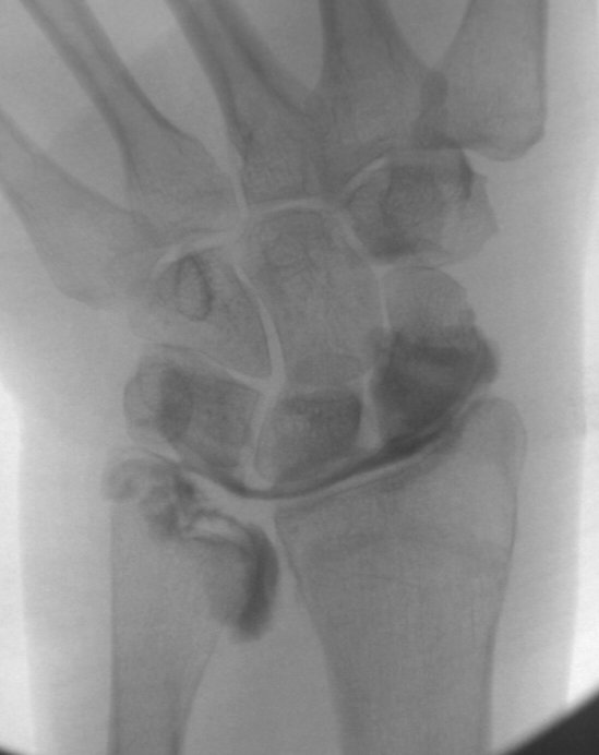 #CaseOfTheWeek🎉

📢✅Answer for Case #11: TFCC tear on arthrogram

Have a great week!!🥳🎉

#FOAMrad #RadEd #MedEd #OrthoEd #OrthoTwitter @ssr_rwg @UWRadRes @HandSociety