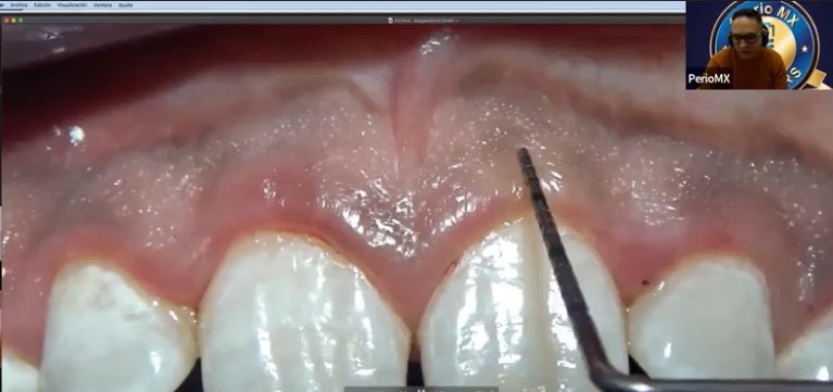 PerioMX's tweet image. En la actualidad existen guías quirúrgicas impresas o digitales que nos ayudan a que el punto de sangrado ya no se tenga que realizar. 
#PerioMX #periomembers #puntosdesangrado #periodonciaenlaactualidad