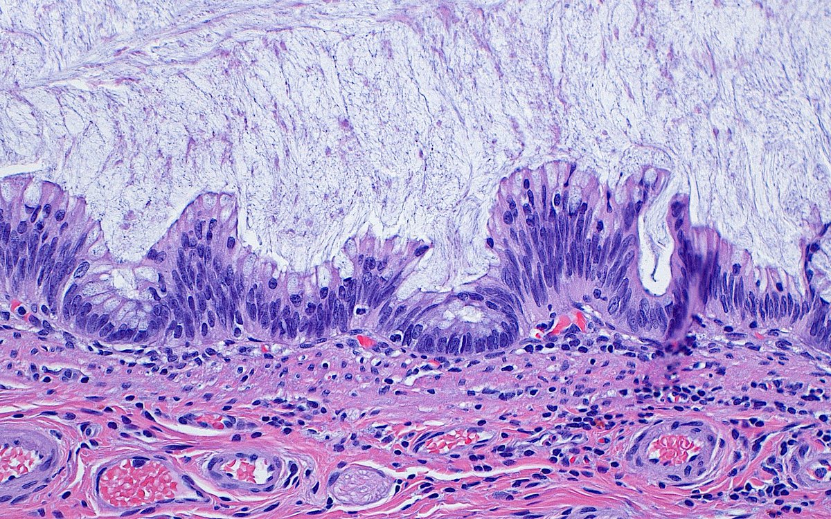 Low-grade appendiceal mucinous neoplasm (LAMN) ~ #GIpath #appendix #pathology #PathArt